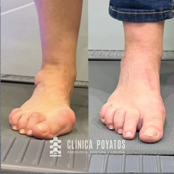 cirugia-juanetes-resultados antes y despues de cirugia juanetes malaga