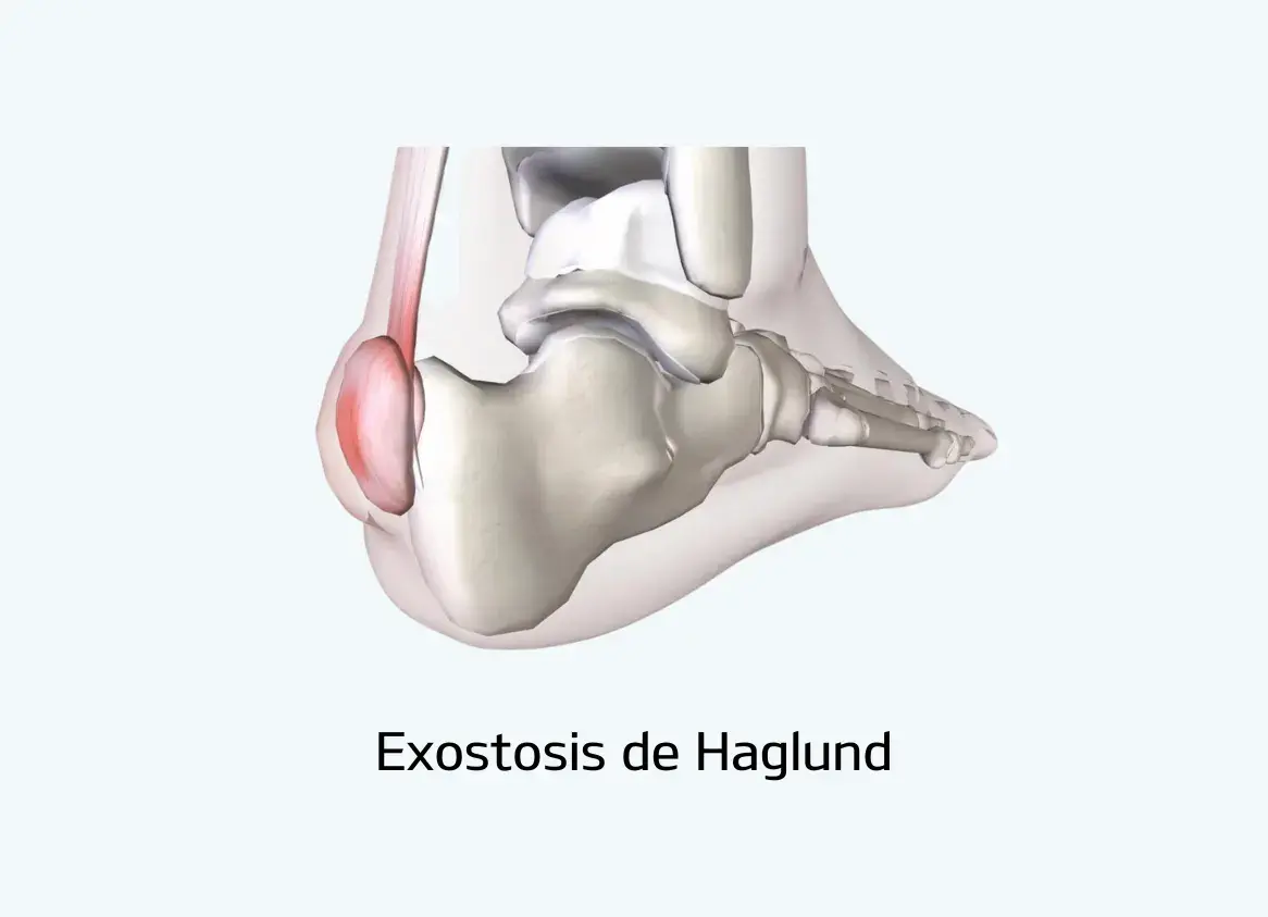 exostosis-haglund-malaga exostosis haglund malaga