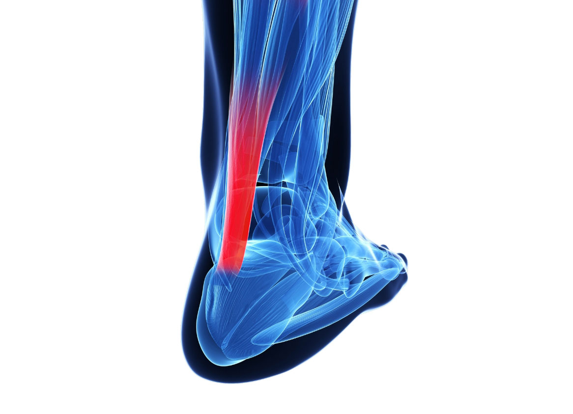 tratamiento-tendinitis-aquiles-clinica-poyatos tratamiento tendinitis aquiles clinica poyatos