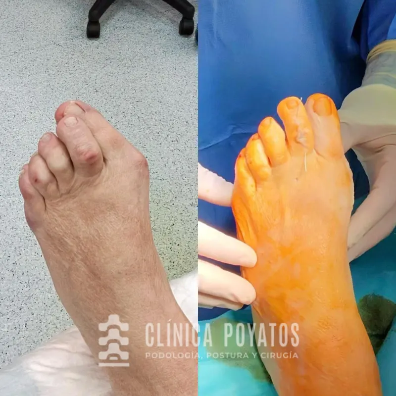 antes-despues-clinica-poyatos-juanetes-operacion-1 operacion juanete