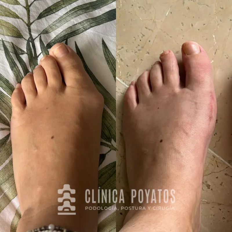antes-despues-clinica-poyatos-juanetes-operacion-2 cirugia de juenete en malaga