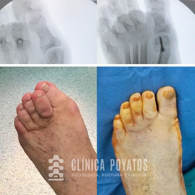 antes-despues-cirugia-del-pie-malaga-poyatos-2 operacion segunda vez cirugia pie malaga