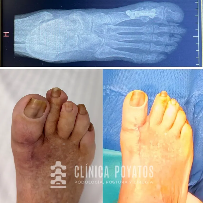 antes-despues-cirugia-del-pie-malaga-poyatos operacion pie malaga