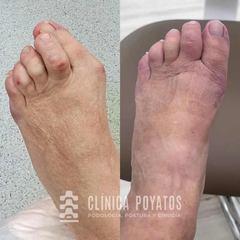 cirugia-juanete-dedos-en-garra-clinica-poyatos antes y despues cirugia de juanetes